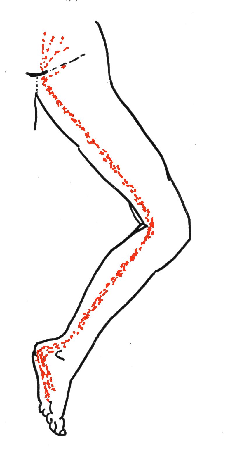 Linear Red Rash Linear Skin Rashes and the Meridians of Acupuncture